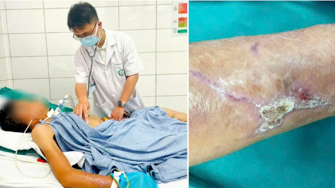 Su&yacute;t mất mạng v&igrave; chủ quan với vết thương ngo&agrave;i da