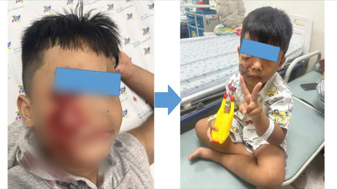 Cấp cứu b&eacute; trai 5 tuổi bị ch&oacute; tấn c&ocirc;ng