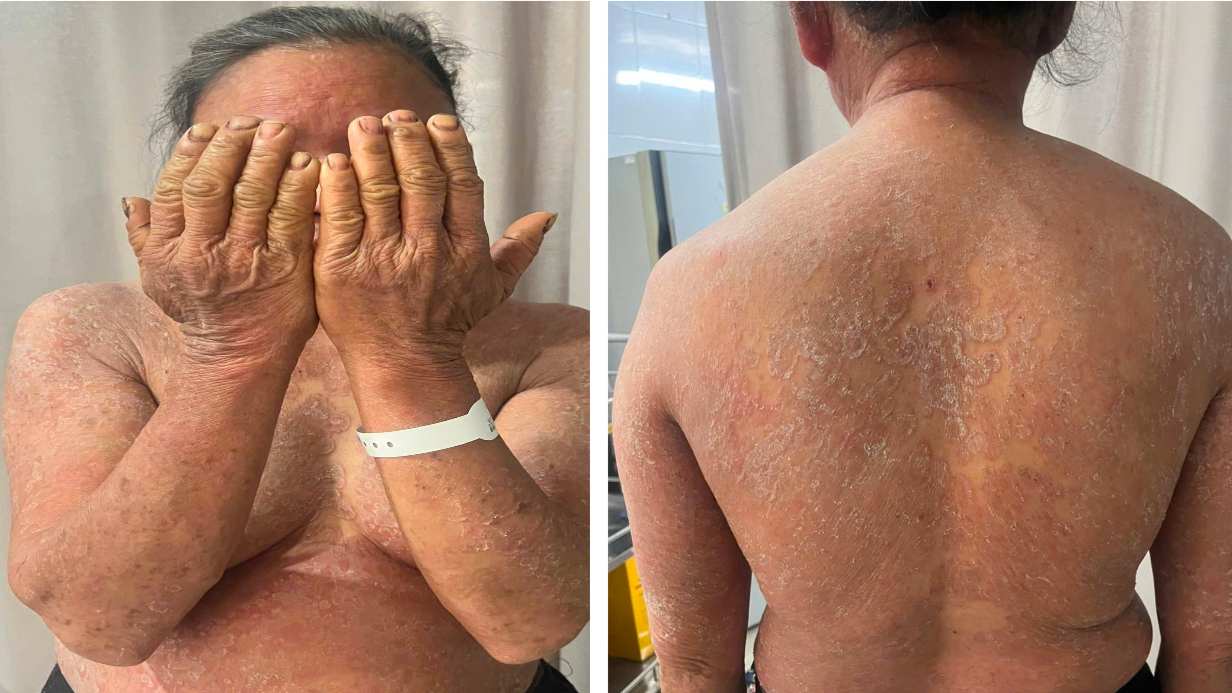 Đừng biến bệnh nấm da th&agrave;nh 'thảm họa' v&igrave; thuốc b&ocirc;i kh&ocirc;ng r&otilde; loại