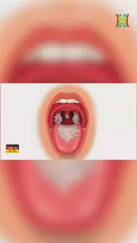Bạch hầu, bệnh truyền nhiễm nguy hiểm