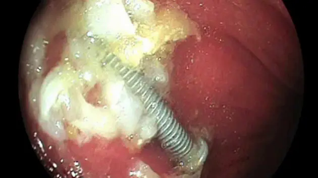 Gắp th&agrave;nh c&ocirc;ng đinh v&iacute;t d&agrave;i 5cm trong dạ d&agrave;y b&eacute; 15 th&aacute;ng tuổi