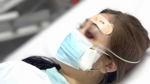 C&ocirc; g&aacute;i bị m&ugrave; mắt vĩnh viễn do ti&ecirc;m filler tại nh&agrave;