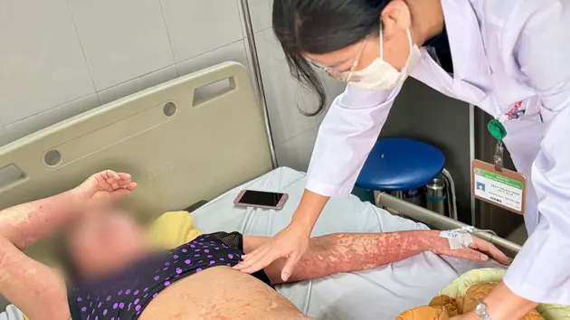 Cụ b&agrave; biến dạng khu&ocirc;n mặt v&igrave; dị ứng thuốc nặng