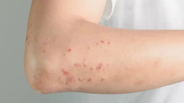Ghi nhận bệnh nh&acirc;n đầu ti&ecirc;n tử vong nghi do bệnh sởi