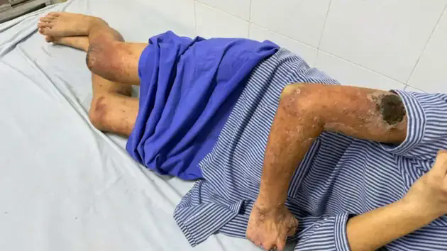 Nam thanh ni&ecirc;n tổn thương da do đắp kiến ba khoang