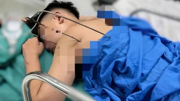Cứu sống nam thanh ni&ecirc;n bị dị vật đ&acirc;m thấu tim