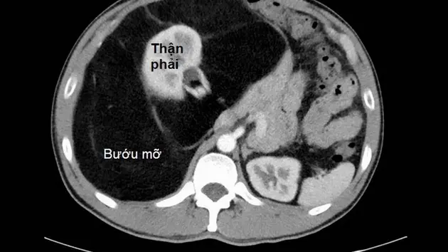 Người đ&agrave;n &ocirc;ng c&oacute; khối u 8kg nhưng tưởng nhầm 'bụng bia'