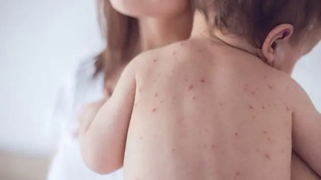 Sởi l&acirc;y lan mạnh, tỷ lệ ti&ecirc;m chủng chưa đạt y&ecirc;u cầu