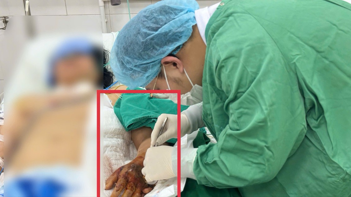 Bàn tay hoại tử đen kịt, suy đa tạng sau hai ngày chỉ từ một vết tiêm