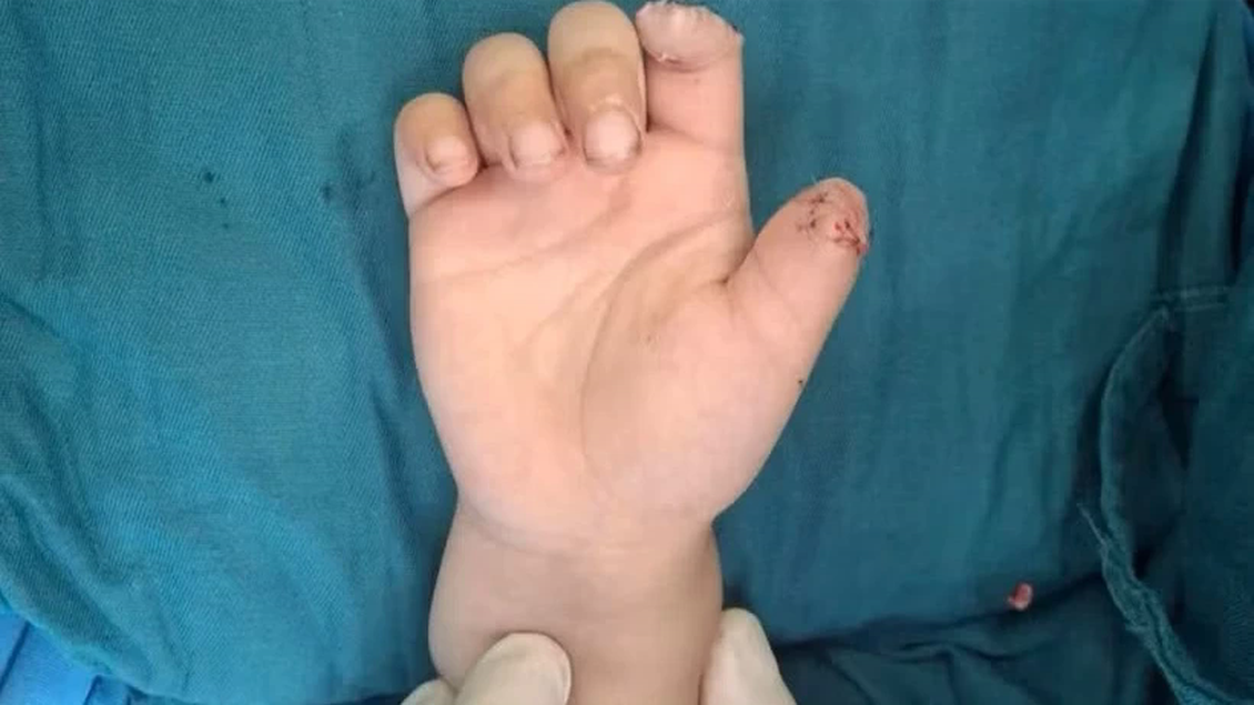 Tai nạn xe điện tự chế, bé 5 tuổi đứt lìa hai ngón tay