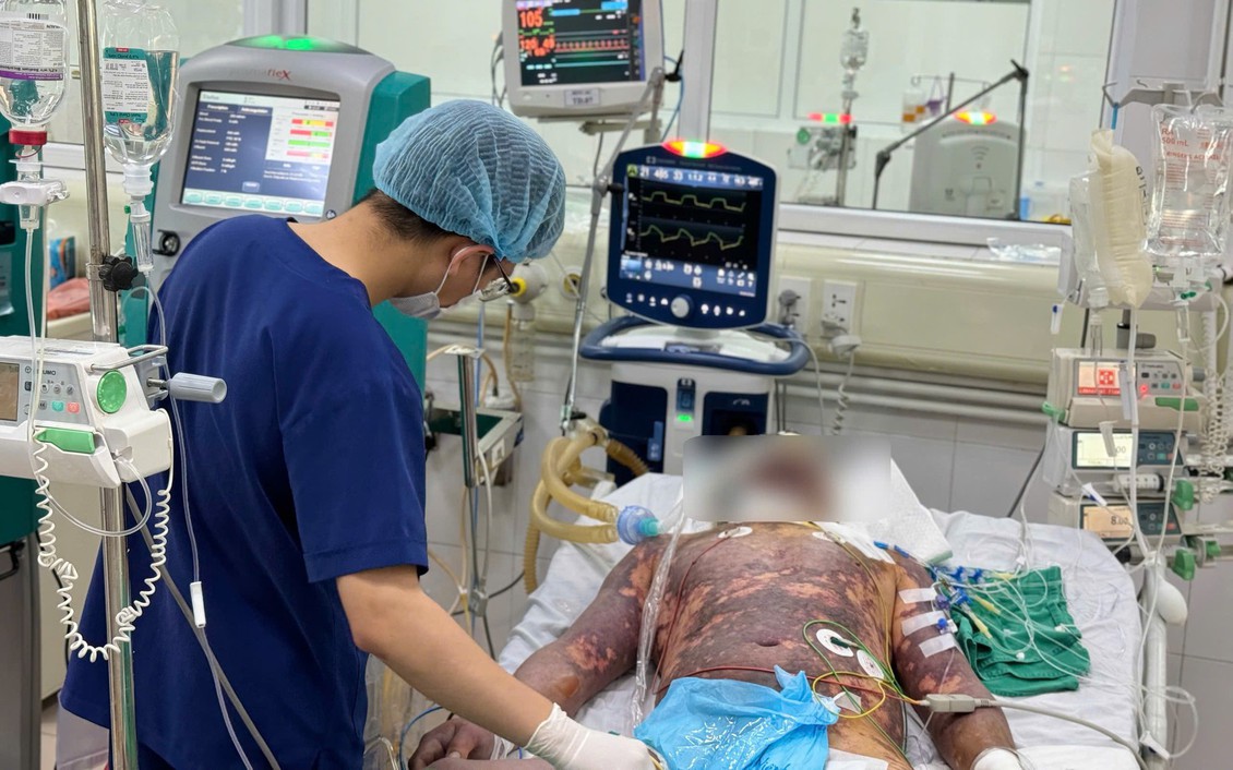 Liên tiếp 4 ca nhiễm liên cầu lợn, có trường hợp suy đa tạng nguy kịch