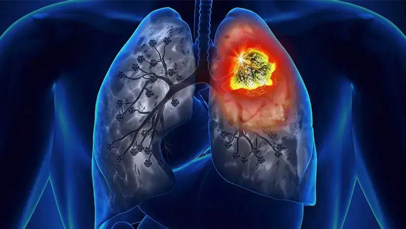 Cập nhật xu hướng mới trong điều trị ung thư phổi