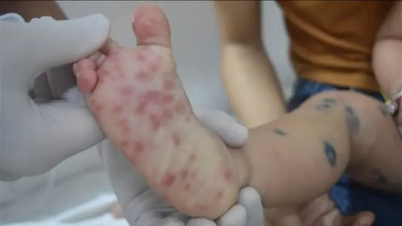 Hà Nội: Nhiều dịch bệnh tăng số ca mắc trong tuần qua