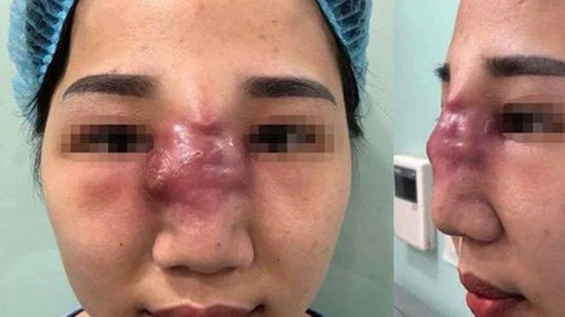 Mỗi năm Việt Nam có 25.000-35.000 ca biến chứng thẩm mỹ