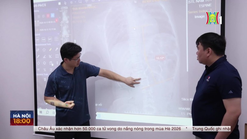 Lần đầu tiên Việt Nam chỉnh vẹo cột sống không ghép xương