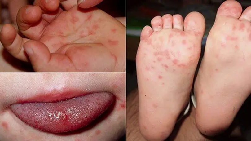 Hà Nội phòng chống, phát hiện sớm bệnh tay chân miệng