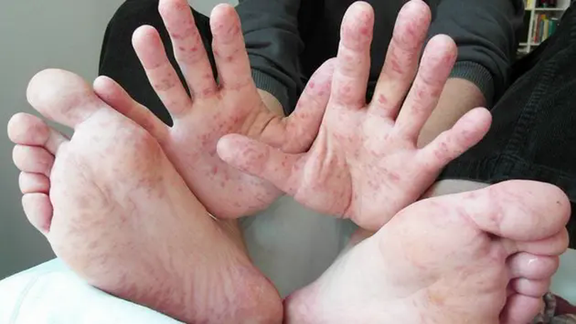 Dịch tay chân miệng dễ bùng phát khi giao mùa