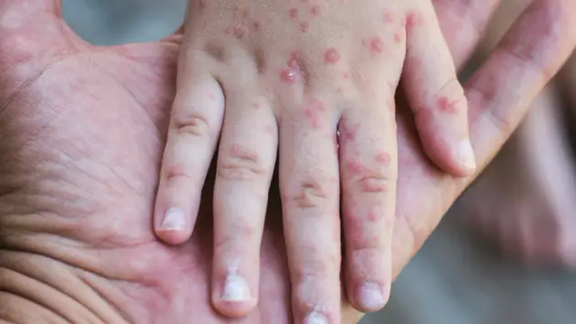 Dịch sởi bùng phát, Mỹ kêu gọi tiêm vaccine diện rộng