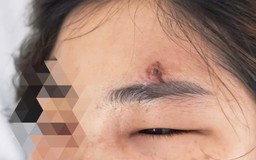 Nhập viện cấp cứu vì biến chứng do nặn mụn sai cách
