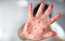 Tăng cường phòng, chống bệnh sốt xuất huyết, tay chân miệng