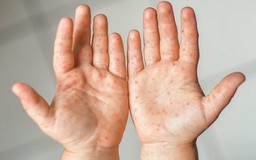 Hà Nội ghi nhận 5 ổ dịch tay chân miệng