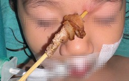 Cứu bé gái bị que xiên thịt đâm suýt vỡ nhãn cầu