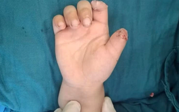 Tai nạn xe điện tự chế, bé 5 tuổi đứt lìa hai ngón tay