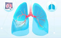 Bệnh viện Bạch Mai khám sàng lọc ung thư phổi miễn phí