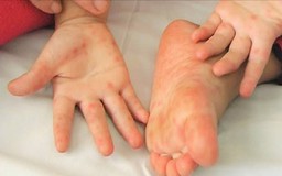 Tay chân miệng vào mùa, dù có vaccine, vẫn không thể chủ quan