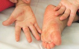 Tay chân miệng tăng 2,5 lần, nguy cơ dịch bệnh lây lan nhanh khi năm học mới bắt đầu