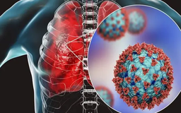 Việt Nam chủ động phòng chống bệnh do virus HMPV gây ra