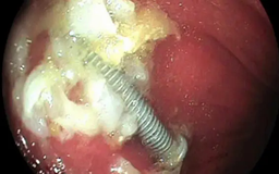Gắp thành công đinh vít dài 5cm trong dạ dày bé 15 tháng tuổi