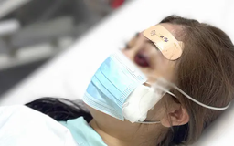 Cô gái bị mù mắt vĩnh viễn do tiêm filler tại nhà