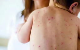Bộ y tế cảnh báo dịch sởi có nguy cơ bùng phát