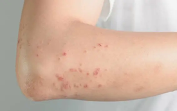 Ghi nhận bệnh nhân đầu tiên tử vong nghi do bệnh sởi