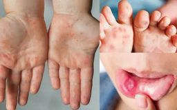 Hà Nội có hơn 300 ca mắc tay chân miệng