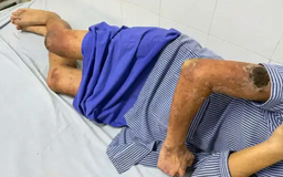 Nam thanh niên tổn thương da do đắp kiến ba khoang