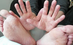 Dịch tay chân miệng dễ bùng phát khi giao mùa