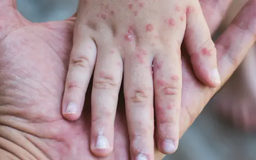 Dịch sởi bùng phát, Mỹ kêu gọi tiêm vaccine diện rộng