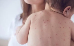 Sởi lây lan mạnh, tỷ lệ tiêm chủng chưa đạt yêu cầu